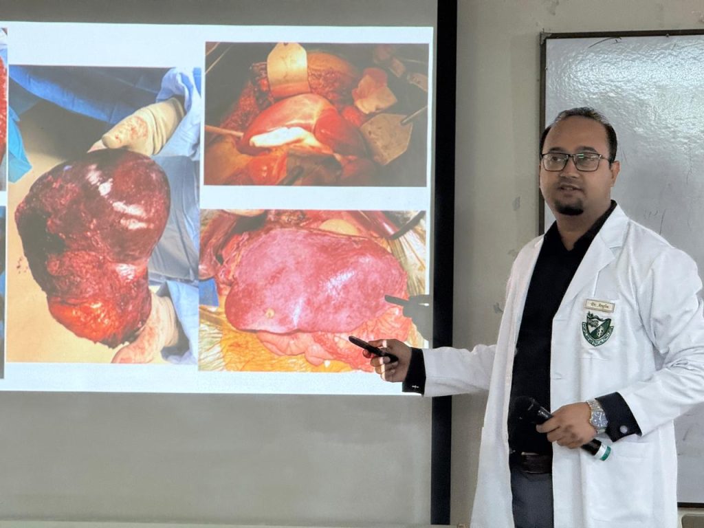 Dr. Murshidul Arefin performing spleen tumor surgery in Dhaka – splenic tumor treatment in Bangladesh.