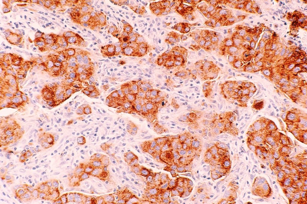 Photo hepatobiliary diseases
