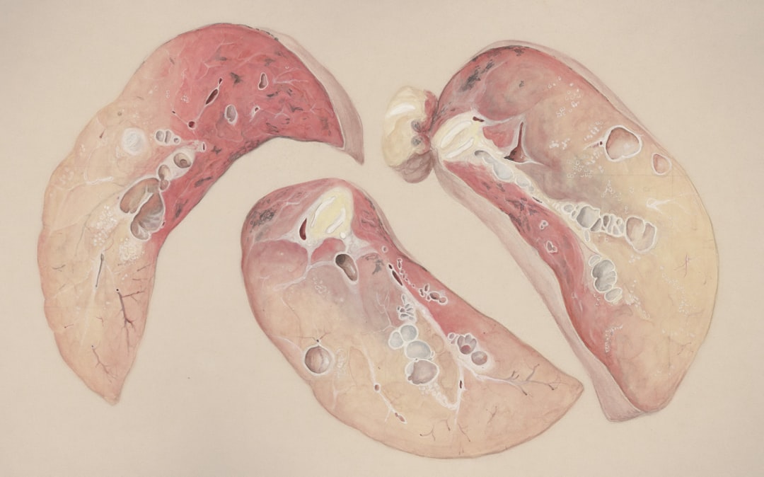 Photo Liver Cyst