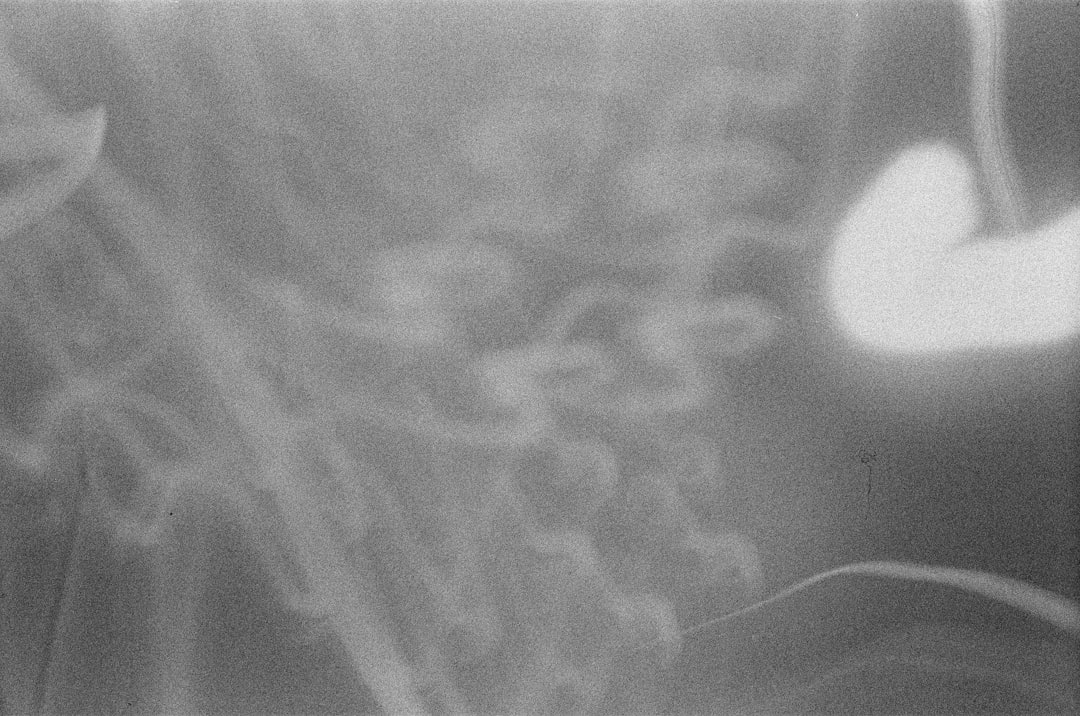 Photo Spleen Rupture